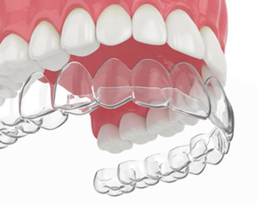 CLEAR ALIGNERS
