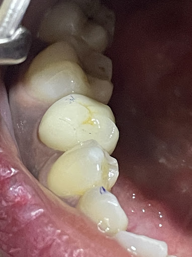 ENDODONTIST NEAR HEBBAL
